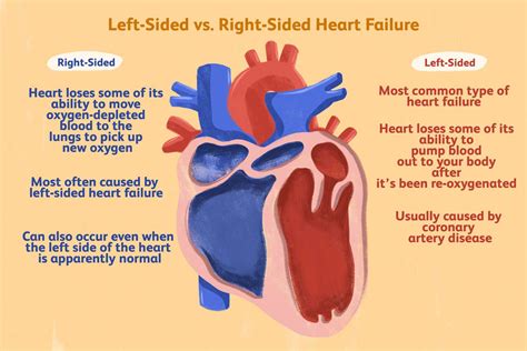 treatment for left sided heart failure.